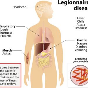 Legionnaires disease or legionellosis